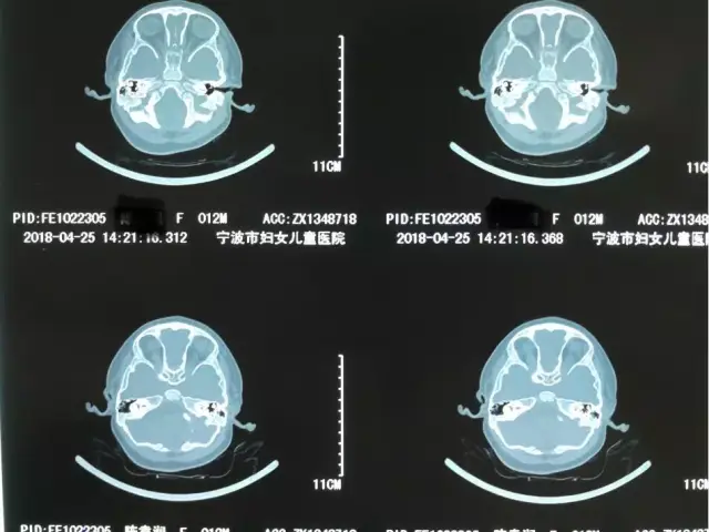 医院ct报告诊断:两侧听小骨形态异常.