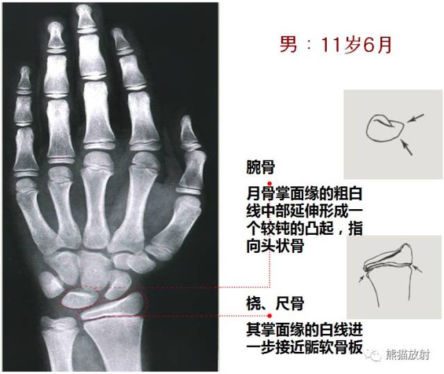 这些男,女性骨龄图谱,你都掌握了吗?