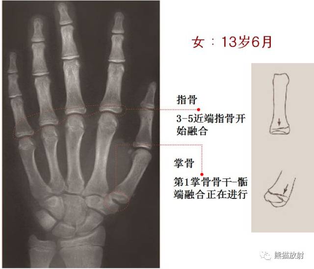 提前:骨龄比生活年龄大1岁以上; 延迟:骨龄比生活年龄小1岁以上
