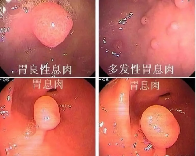 肠息肉,胃息肉,胆息肉,鼻息肉…切还是不切?