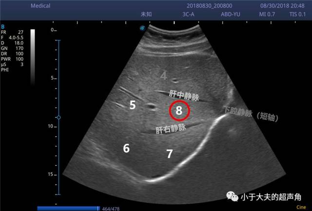 其实不难, 关键是确定 8段 在哪里,即肝右前叶上段,其位置最高且靠前