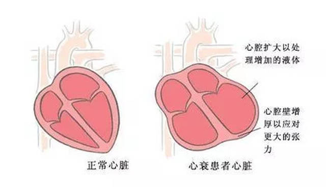 乏力头晕,呼吸困难,脚肿,腹胀恶心……这些可能是心衰