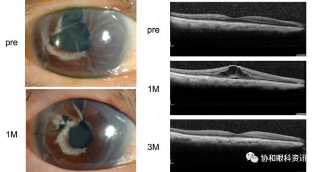 文摘速递丨角膜内皮移植术后黄斑囊样水肿
