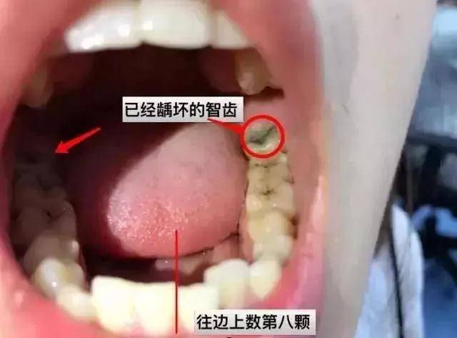 智齿反复发炎"捅破"脸!智牙到底要不要拔?