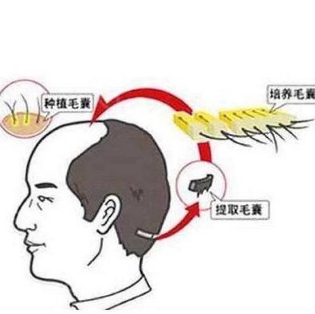 植发后从脱落期到生长茂盛期的过程