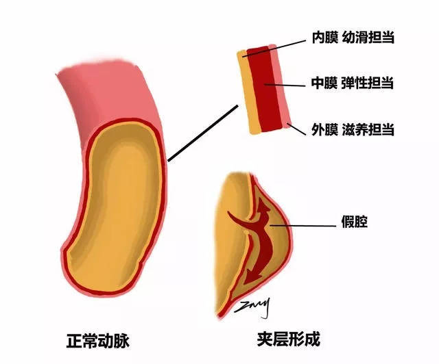 血流进入主动脉壁内,导致血管壁分层,剥离的内膜片将主动脉分隔形成"