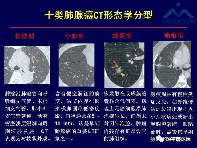 肺癌的ct影像学特征及临床意义 | 影像天地