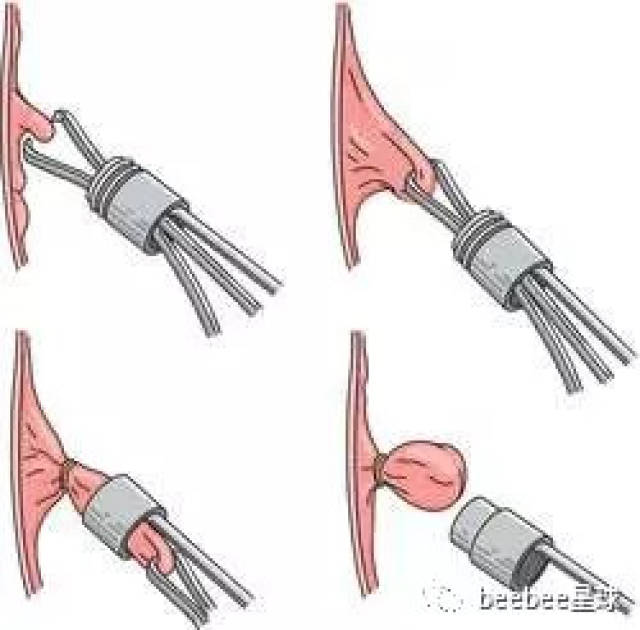 for hemorrhoids)能够通过仪器绑住痔垫,一周内痔疮自我萎缩并脱落