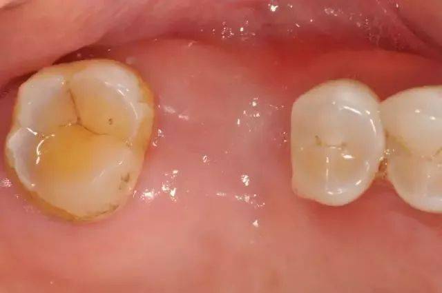 作用效果 填充胶原蛋白海绵后,减轻拔牙疼痛感,预防干槽症及感染;修