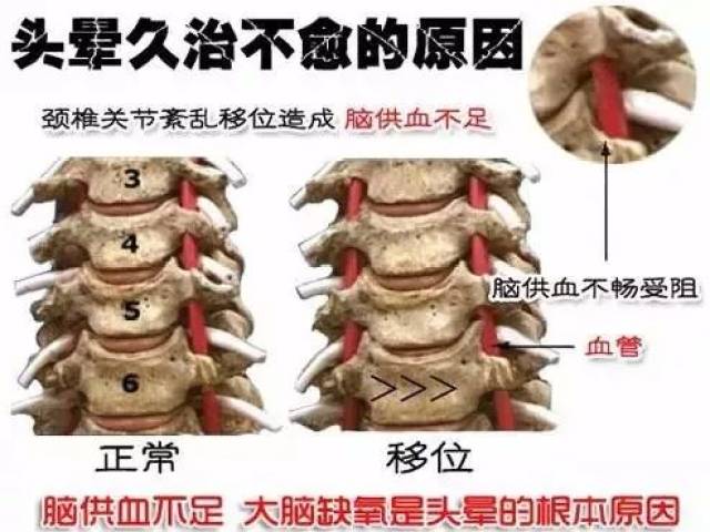 从而颈部动脉和神经受到压迫 阻碍血液流通引发脑供血不足 就会导致