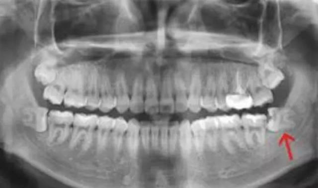 神奇的超声骨刀--拔牙术后无下唇麻木