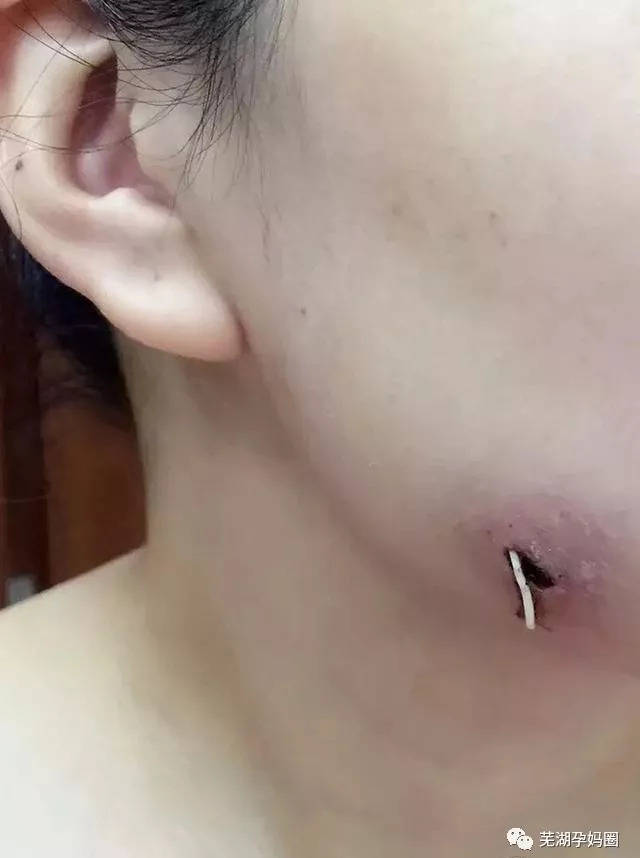孕妇只因为智齿感染发炎,只能在脸上切开拔除!宝妈们都需要注意了!