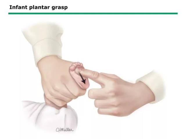 抓握反射(infant plantar grasp:新生儿的手掌和足底都可出现抓握
