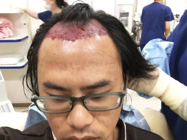 一个日本小哥直播了自己植发的过程,看着头皮发麻啊.