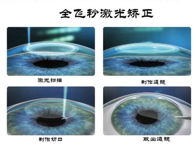 近视矫正手术的原理_从原理讲透彻 东莞全飞秒近视手术的利与弊(2)