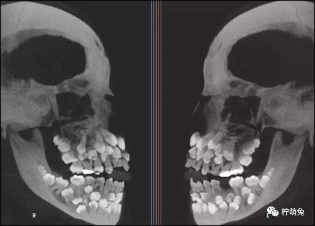 一些奇奇怪怪的x光照片 01  这脚趾头,有点特别 一名"多齿症"患者的
