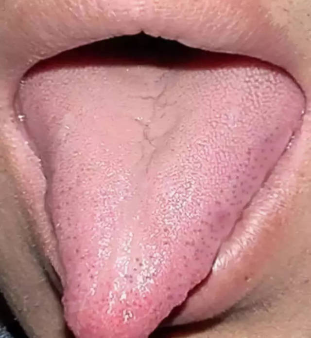 舌体比正常舌瘦小而薄,称为瘦薄舌. 【临