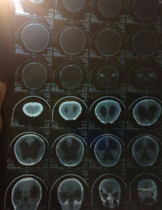 【专家答疑】11个月小孩磕碰头部ct竟查出脑积水