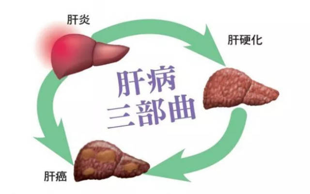轻度肝硬化常见症状有食量减少,上腹痛,倦怠,乏力,体重减轻等.