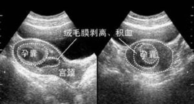 当绒毛膜和子宫壁分离时会引起出血,出血量不固定,颜色偏暗,亦可无