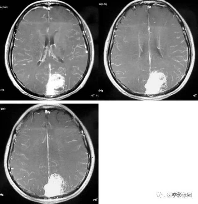 病理结果:恶性脑膜瘤 分 析 恶性脑膜瘤是指具有某些良性脑膜瘤的特点