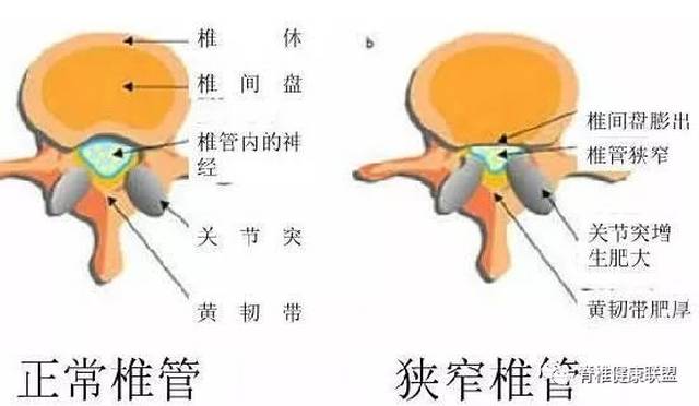 脊柱滑脱性腰椎管狭窄:由于腰椎峡部不连或退变而发生脊椎滑脱时,因