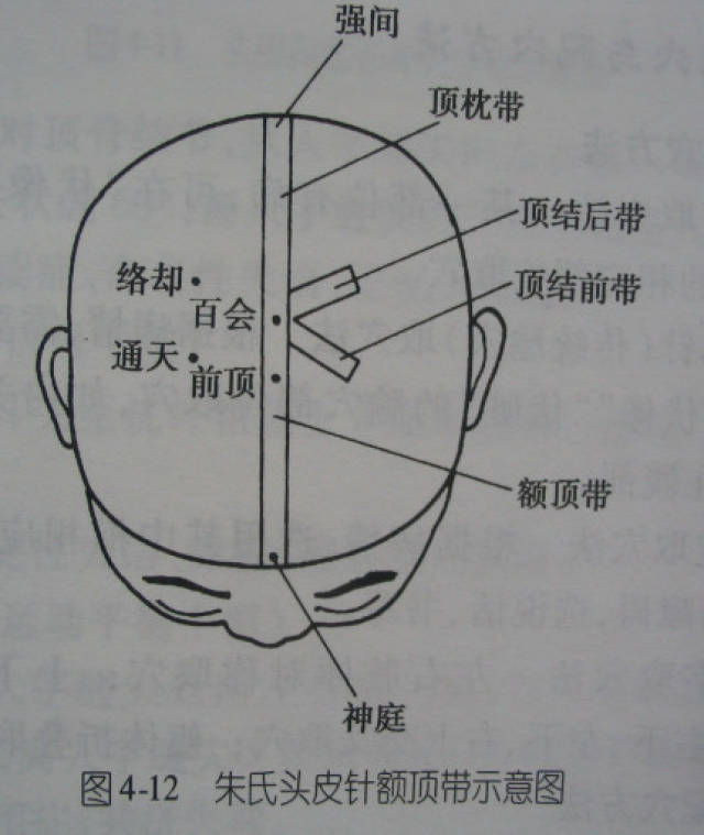 头针:额顶,额旁,顶枕,顶颞,顶节前后,颞前后,8条特定头穴治疗带!