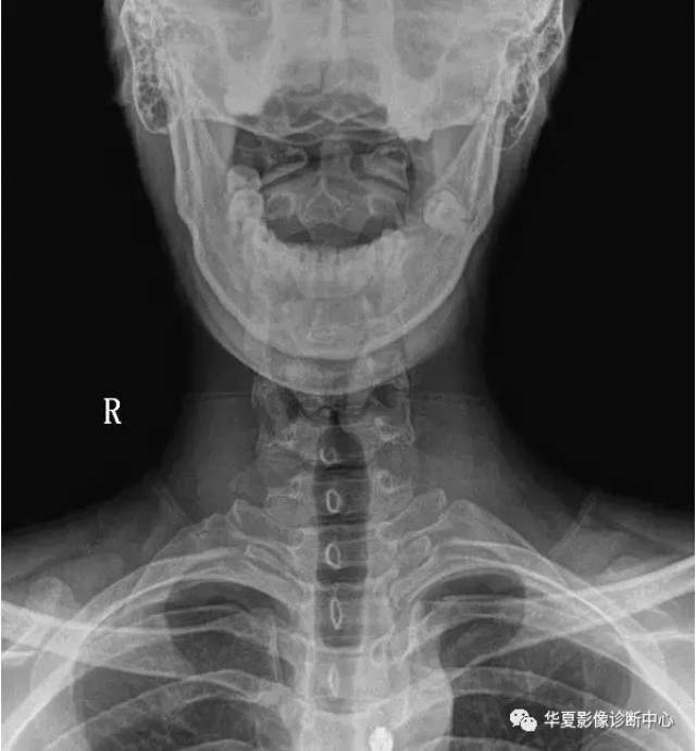 颈椎不适x光片应该这样读