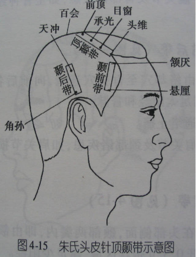 头针:额顶,额旁,顶枕,顶颞,顶节前后,颞前后,8条特定头穴治疗带!