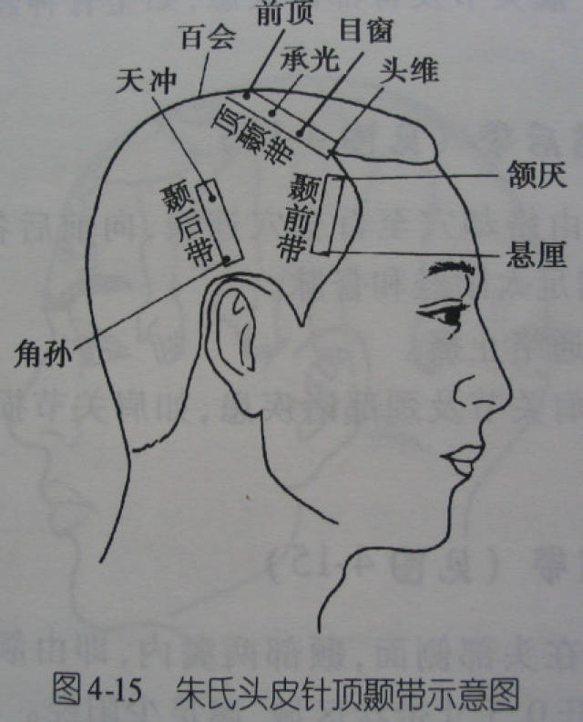 头针:额顶,额旁,顶枕,顶颞,顶节前后,颞前后,8条特定头穴治疗带!