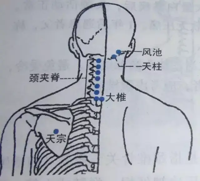 治疗颈椎病穴位:天柱,大椎,百劳穴,颈夹脊,阿是穴(就是痛点,病灶处)