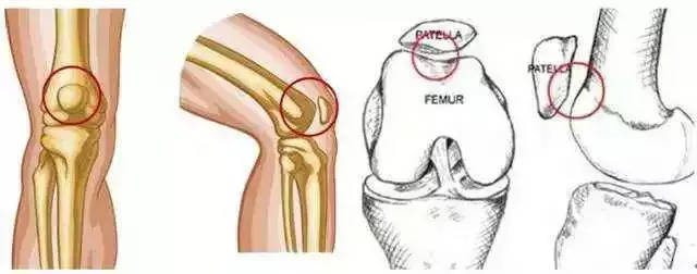 5,股髌症候群(膝关节前部的疼痛)