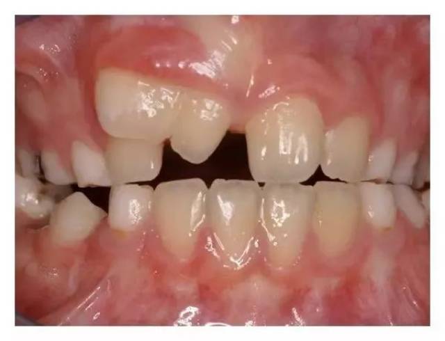 双生牙和融合牙可能导致孩子的牙齿拥挤,牙齿之间产生不规则的间距和