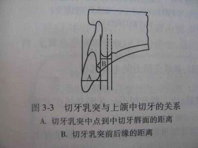 切牙乳突 是制作腊提和排牙时有用的参考标志,在天然牙列,中切牙唇面