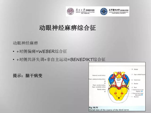 如在临床上同时见到动眼神经麻痹,滑车神经麻痹以及展神经麻痹的