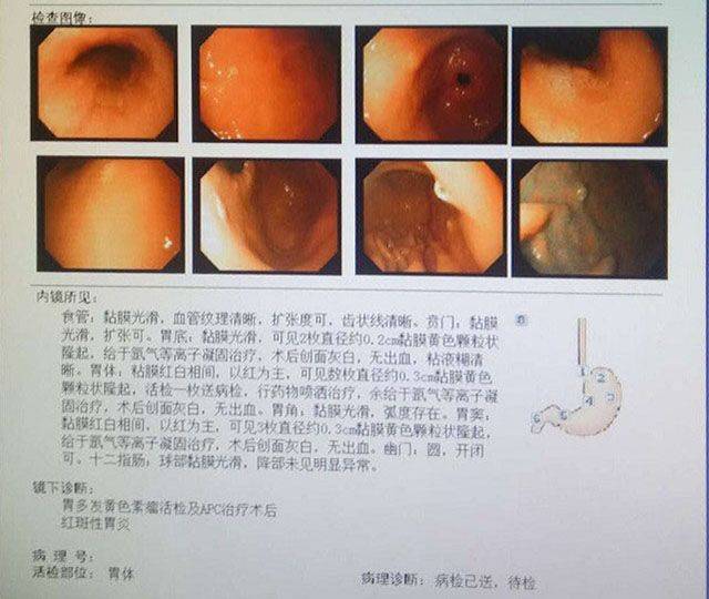 为了保险起见,闫强医生建议徐女士做胃镜检查,明确病因.