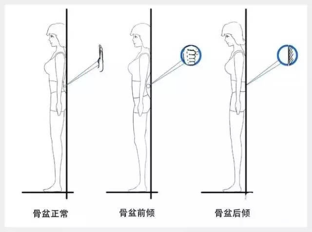 骨盆前倾:骨盆前倾的人会出现脊椎过度弯曲,腰椎前凸.