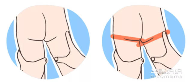 宝宝体检时"腿纹不对称"?医生说可能是这个有问题