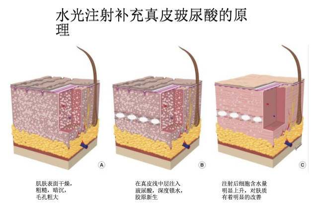 【卢丙仑琅丽】中胚层疗法—你不了解的"真水光!