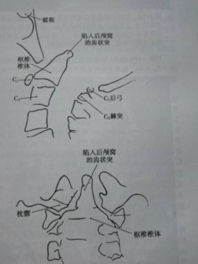 【科普】浅谈颅底陷入症