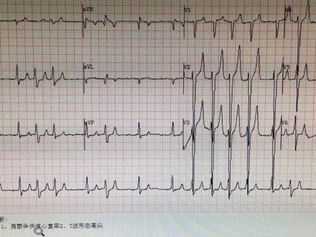 入院时已出现 肾功能不全,心率异常等症状 心电图示房颤伴快速心室率