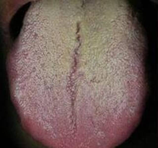 看起来很光滑,这种舌头被称为"镜面舌",也是一种萎缩性舌炎