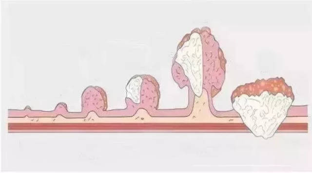 等到出现腹部包块时,往往已发展成肠癌