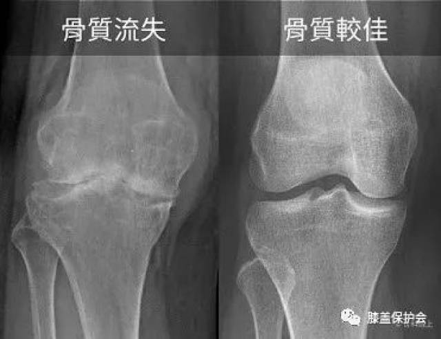 一篇文搞懂常见膝关节疾病x光片判读
