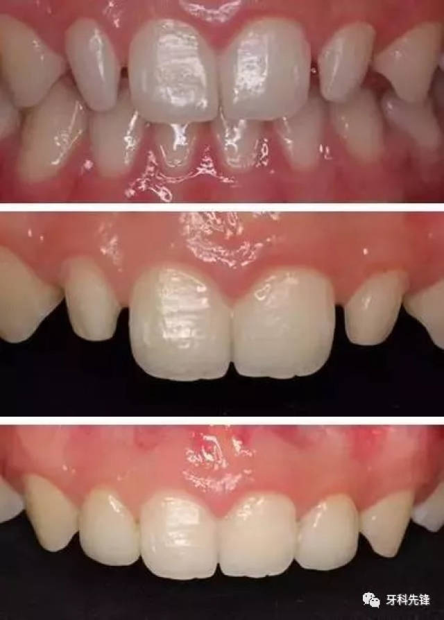 是之前科普小图提到的修复方法 使用在外伤或者根管治疗完善后的牙齿