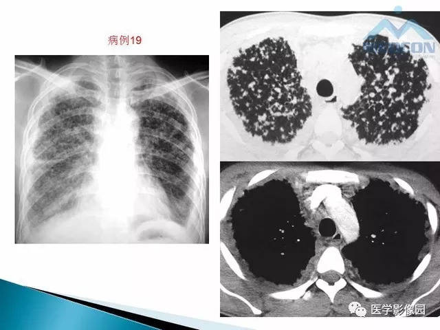 十种不典型肺结核 少见病例影像及其分析 | 影像天地