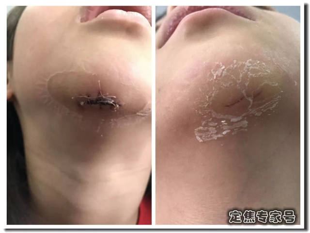 受伤之后别错过三个时机,否则疤痕刺目