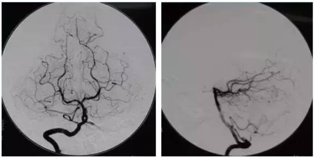 五分钟看懂全脑血管造影