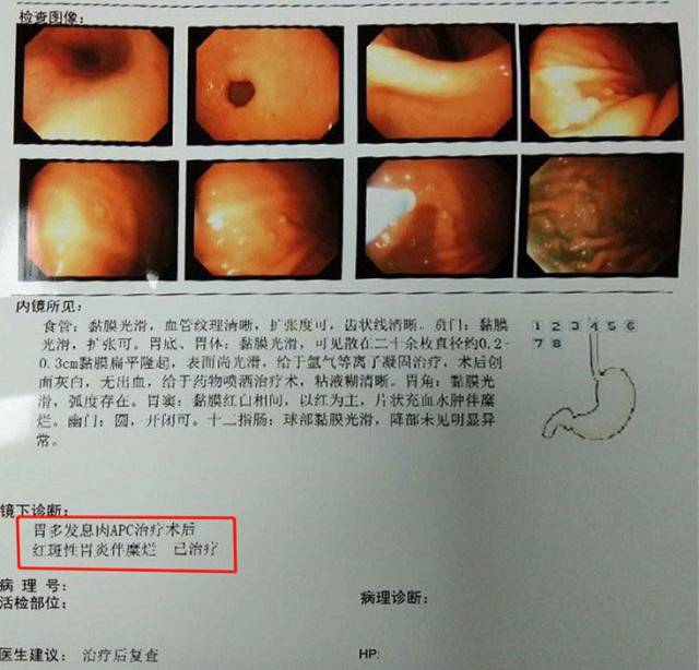 胃炎到癌前病变只用了三个月,原因是.