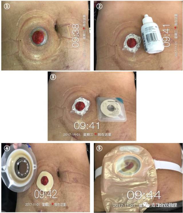 一例回肠造口周围皮肤增生的护理经验分享